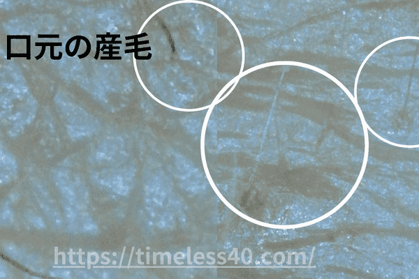 トリアで顔の産毛ケアをした写真